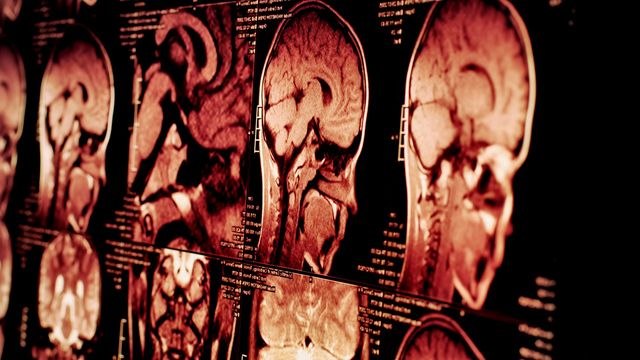 Brain Signaling Distinguishes Parkinson’s From Tremor