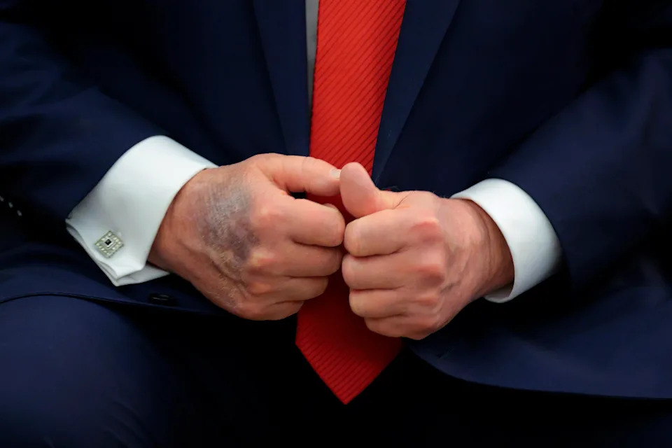 A close-up photo shows that a bruise is visible on the back of President Trump's right hand.