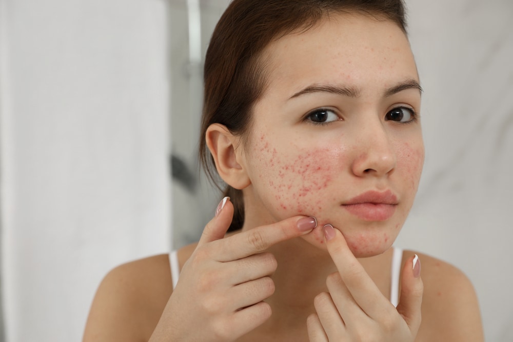 Hormonal acnes happen in adulthood too.(Shutterstock) Hormonal acnes happen in adulthood too.(Shutterstock)