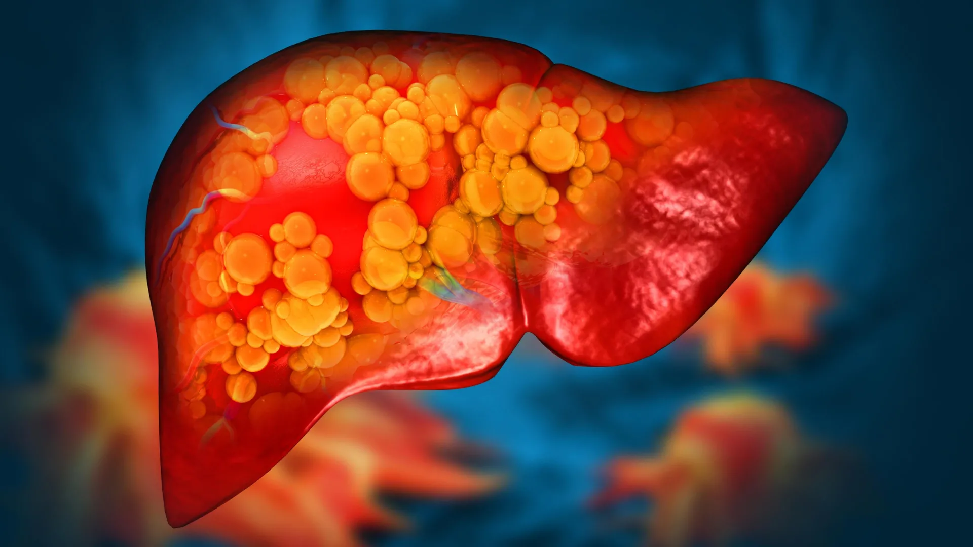 New drug could be first to stop deadly fatty liver disease
