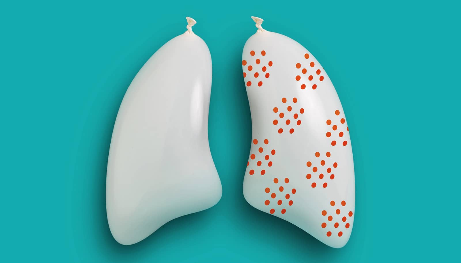 Discovery overturns ideas about small cell lung cancer’s start