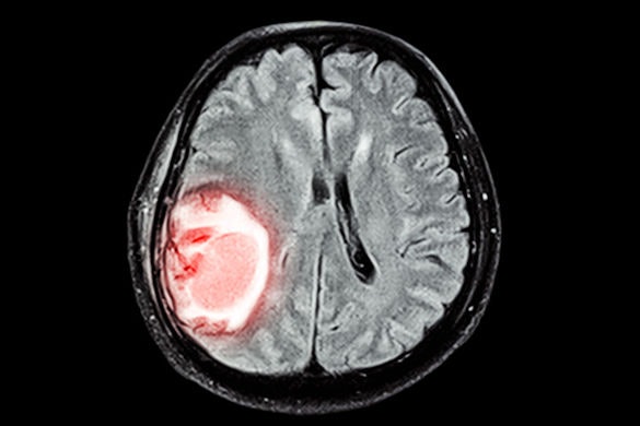 BrainSpec, University of Minnesota collaborate on MR spectroscopy