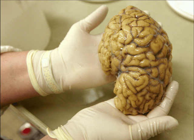 A laboratory assistant holds one hemisphere of a healthy brain in the Morphological unit of psychopathology in the Neuropsychiatry division of the Belle Idee University Hospital in Chene-Bourg near Geneva March 14, 2011.  Source: REUTERS