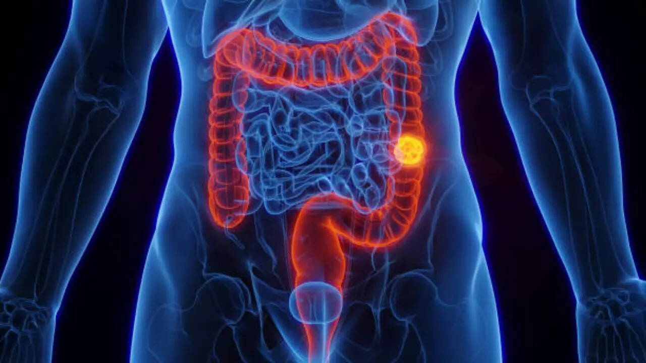 Image credits: Getty Images What is colorectal cancer?
