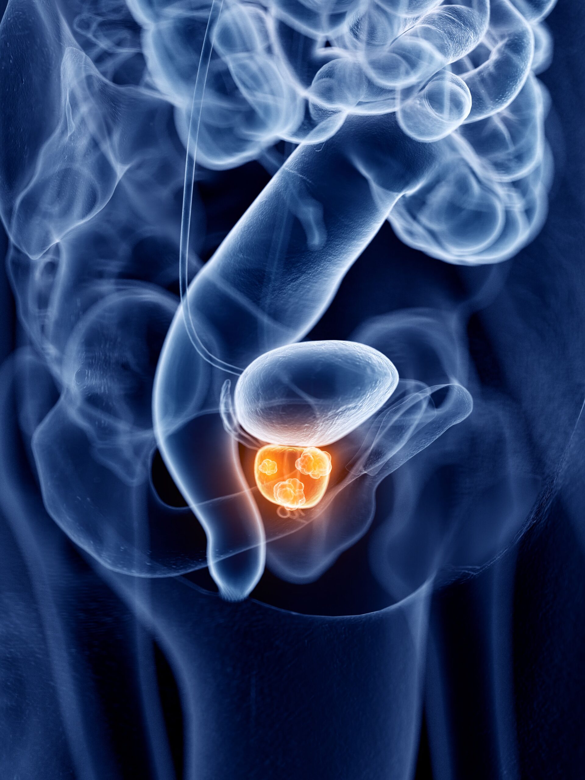 Enzalutamide Combo Shows No MFS Improvement in Advanced Prostate Cancer