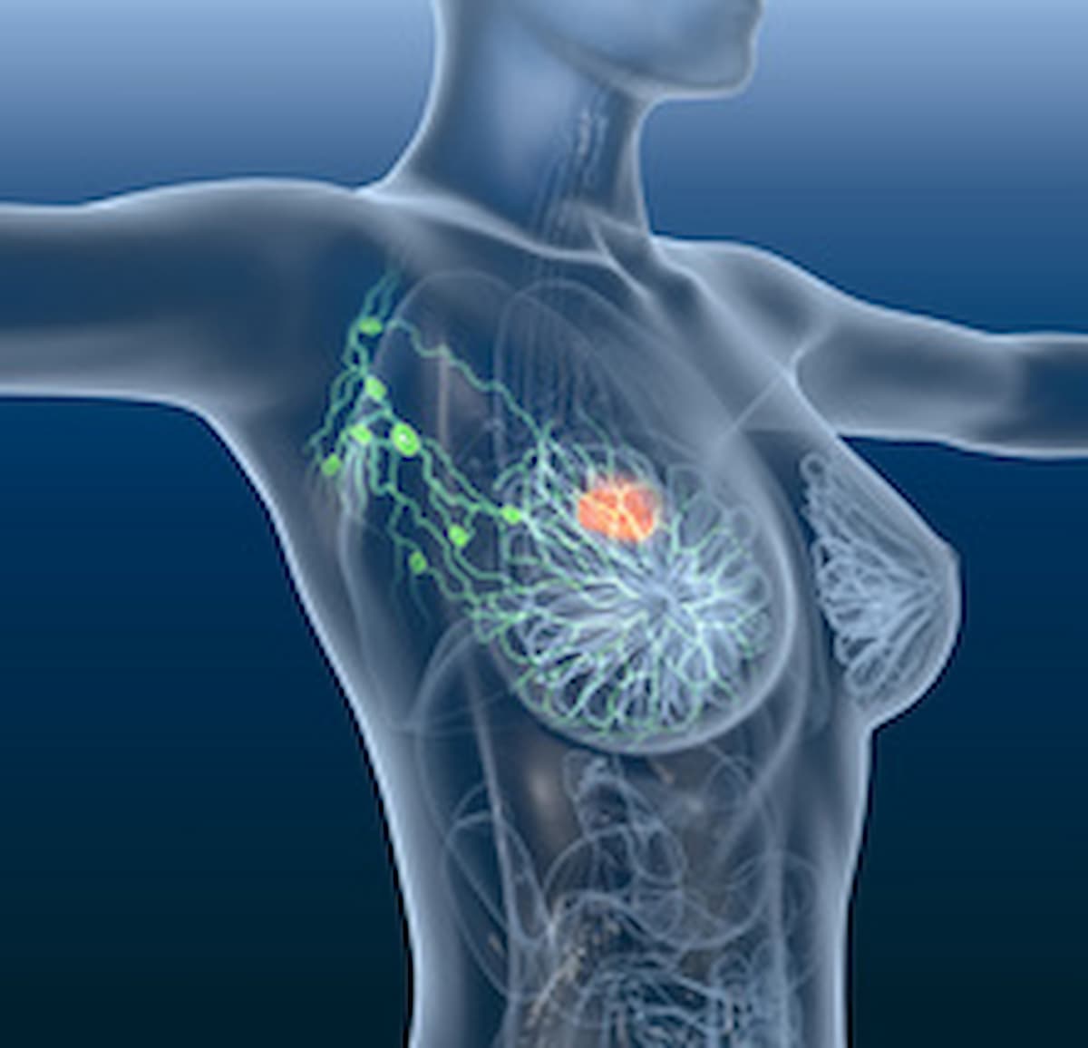 Tucatinib Regimen Improves PFS in HER2+ Metastatic Breast Cancer
