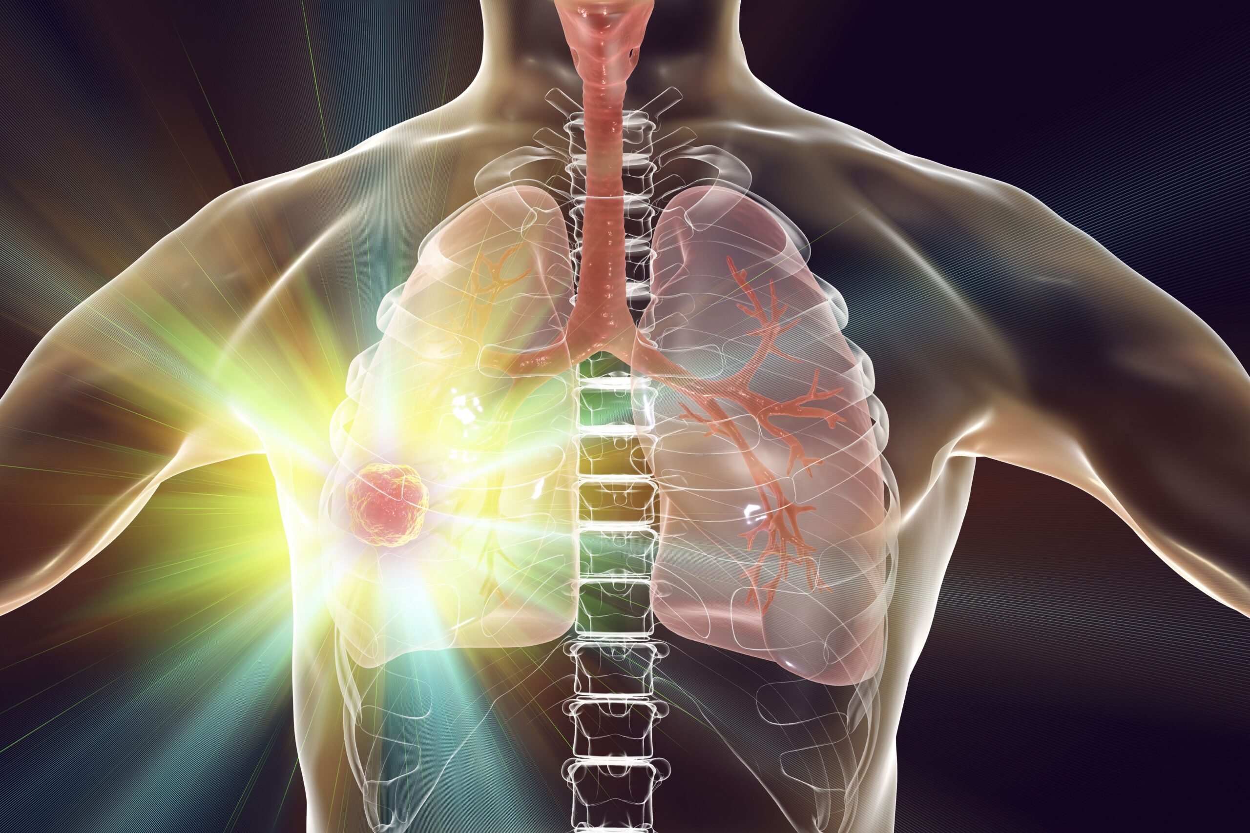 Frontline Immunotherapy Improves OS Vs BRAF/MEK Inhibitors in BRAF+ NSCLC