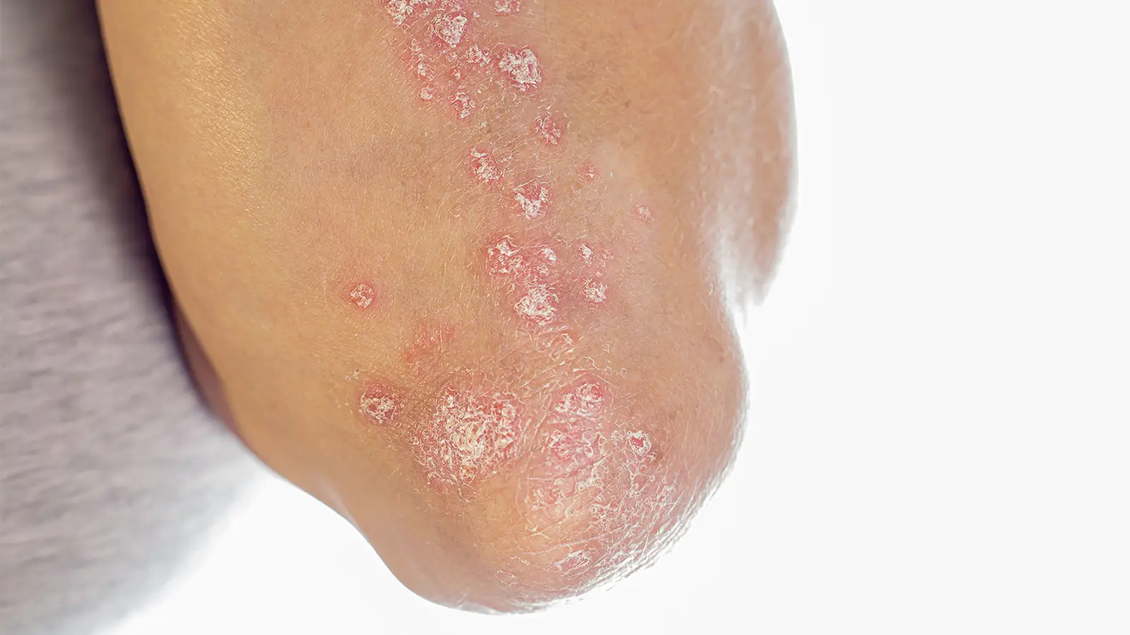 Another IL-17A/F Blocker Moves Forward for Psoriatic Arthritis