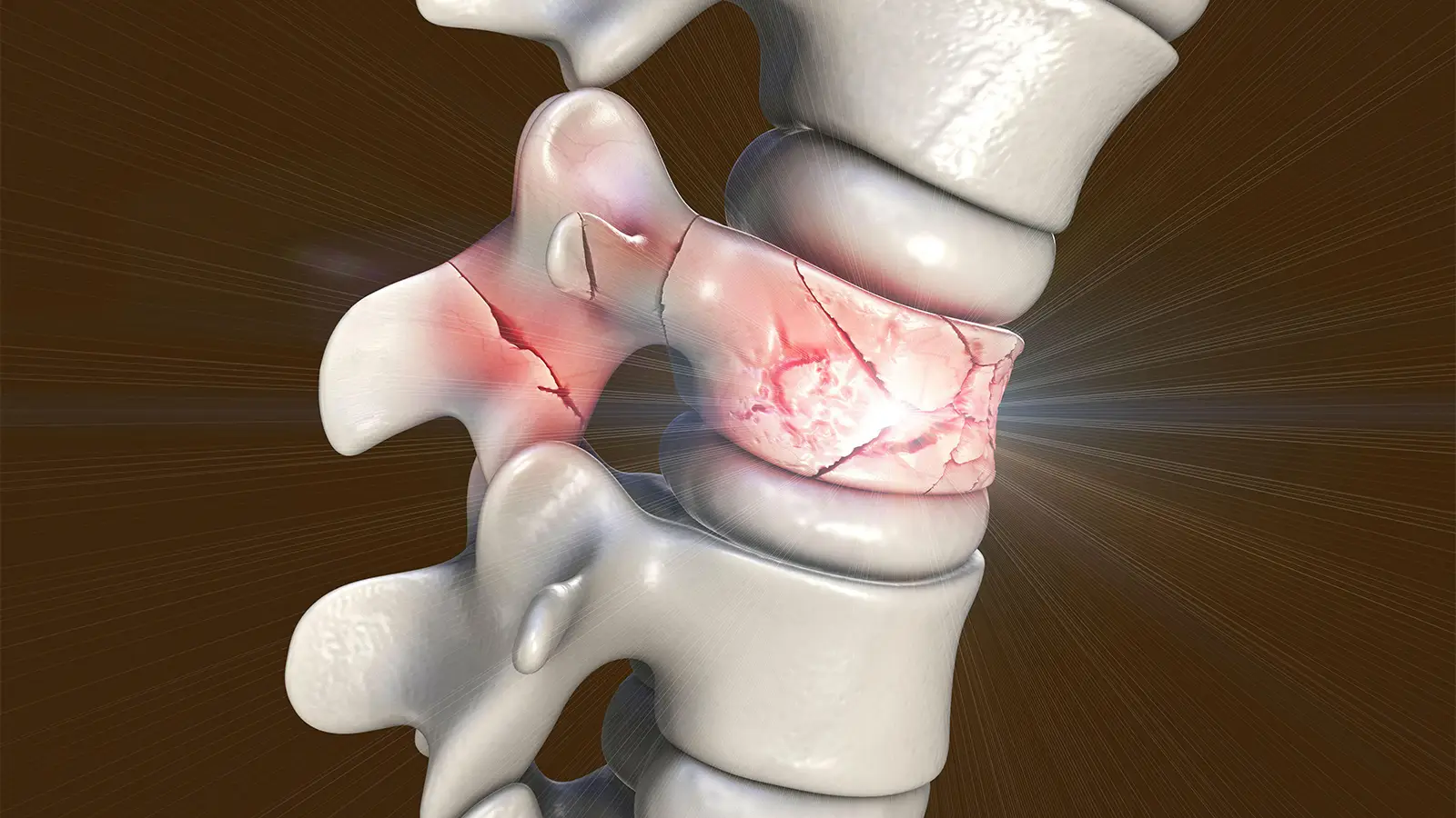 Delayed Fracture Prevention With Infrequent Zoledronate Infusions