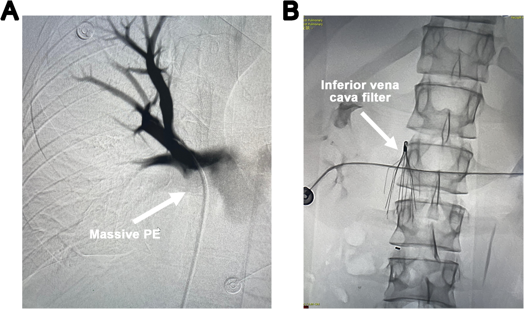 Inserting a venoarterial extracorporeal membrane oxygenation drainage cannula into the inferior vena cava through the internal jugular vein in a patient with an inferior vena cava filter | International Journal of Emergency Medicine