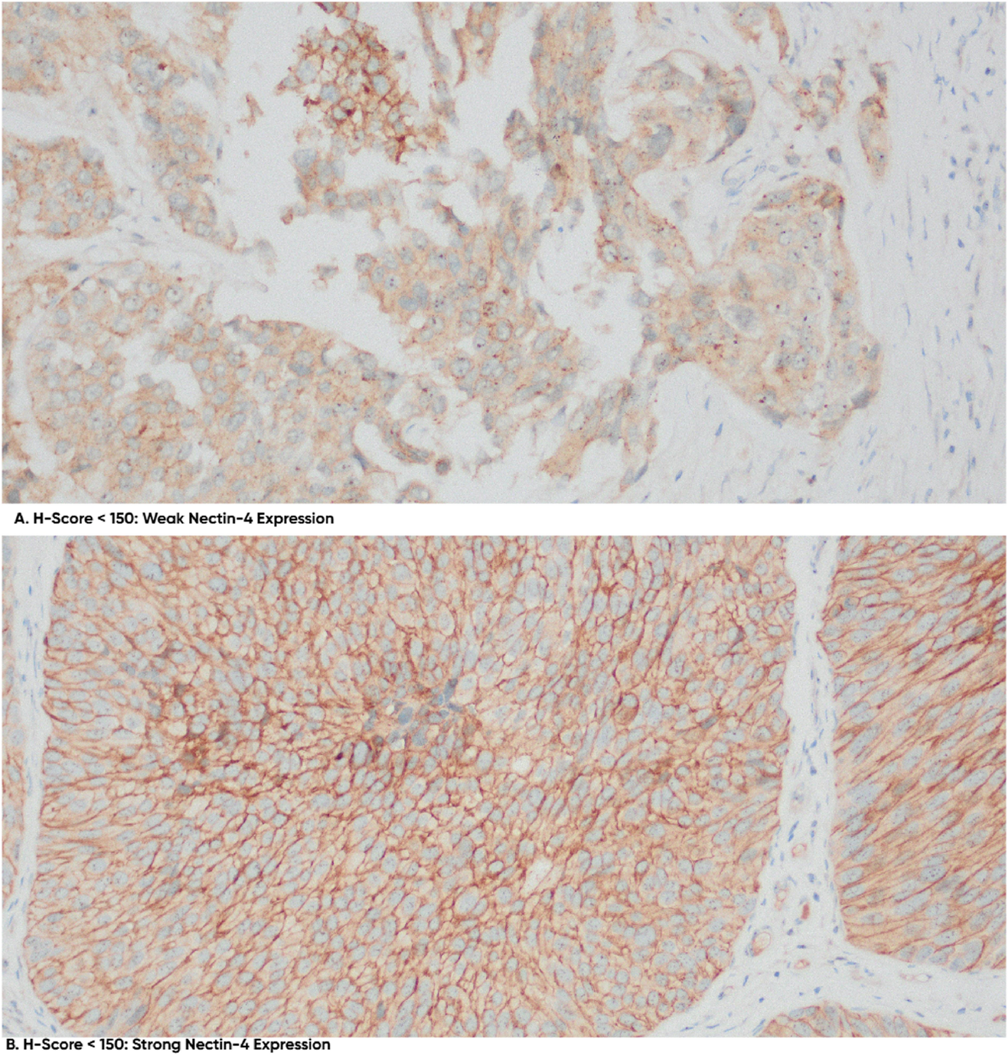 Comparison of molecular profiles (Nectin-4 and TROP-2) in upper tract urothelial carcinoma with a positive history of urinary bladder cancer vs. UTUC only in the era of ADCs | BMC Cancer