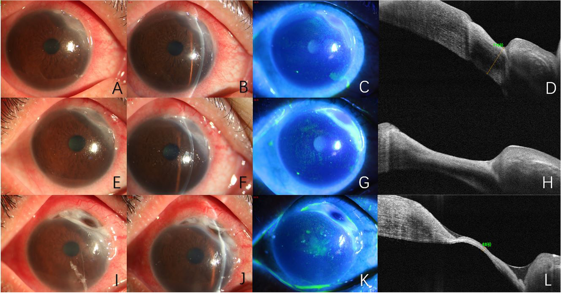 A case report: corneal melting after patch graft in a rheumatoid arthritis patient taking Upadacitinib: paradoxical manifestation or uncontrolled disease activity? | BMC Ophthalmology