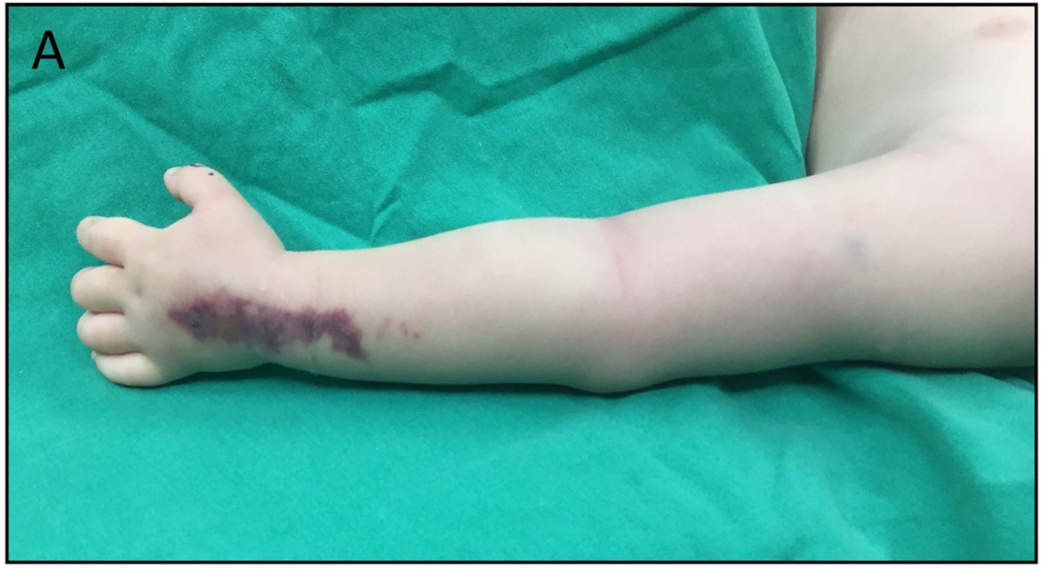 Pediatric necrotizing soft tissue infection: unveiling a rare complication of routine procedures – peripheral venous catheter insertion | BMC Pediatrics