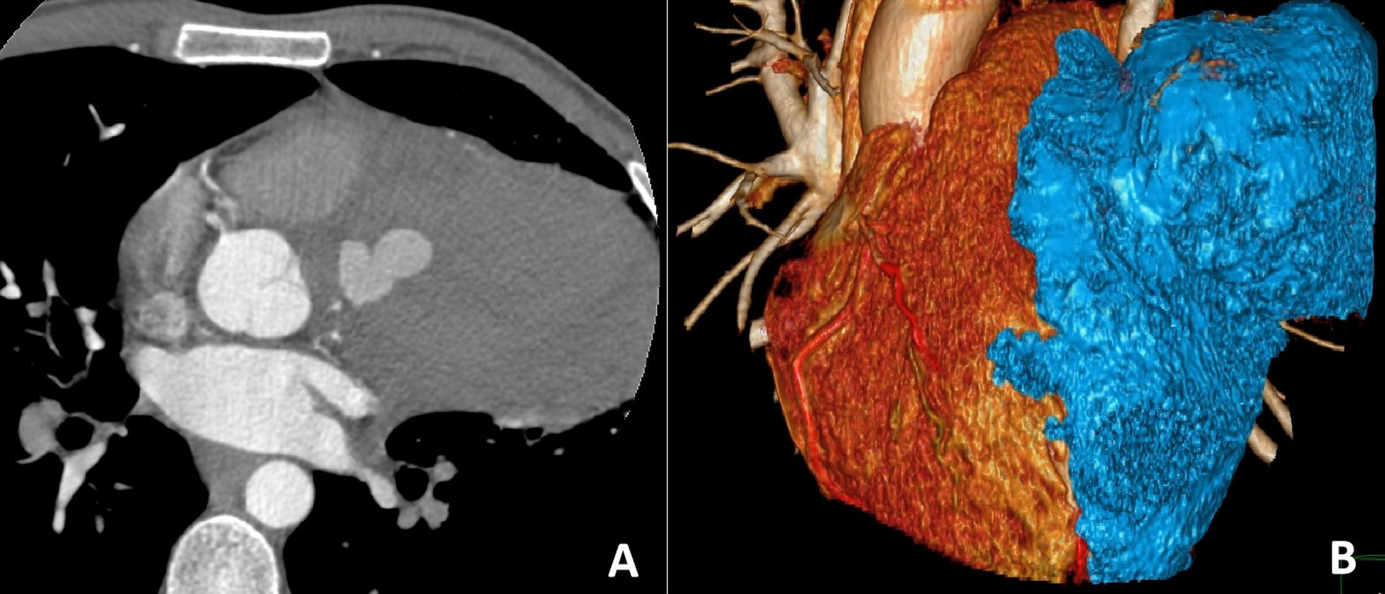 Man in his third decade with a giant coronary artery aneurysm | Journal of Cardiothoracic Surgery