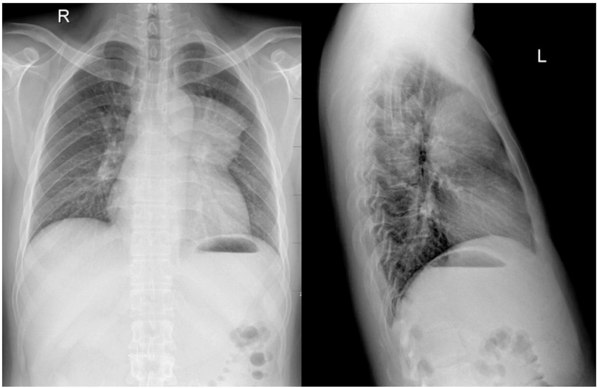 Combined with chemotherapy and radiotherapy is effective in improving prognosis: a case of primary mediastinal embryonal carcinoma | Journal of Cardiothoracic Surgery