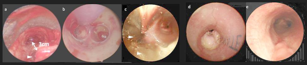 Relapsing polychondritis with catastrophic tracheal injury: extracorporeal membrane oxygenation and silicone Y-stenting for salvage therapy | Journal of Cardiothoracic Surgery