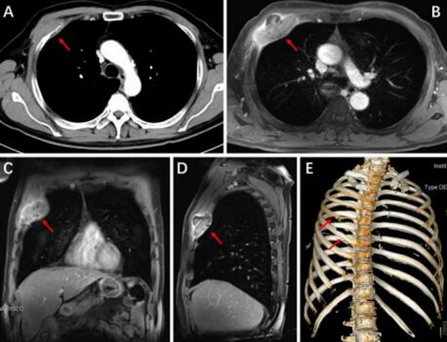 Solitary squamous cell carcinoma of the right chest wall following VATS lobectomy for NSCLC: A rare case report | Journal of Cardiothoracic Surgery