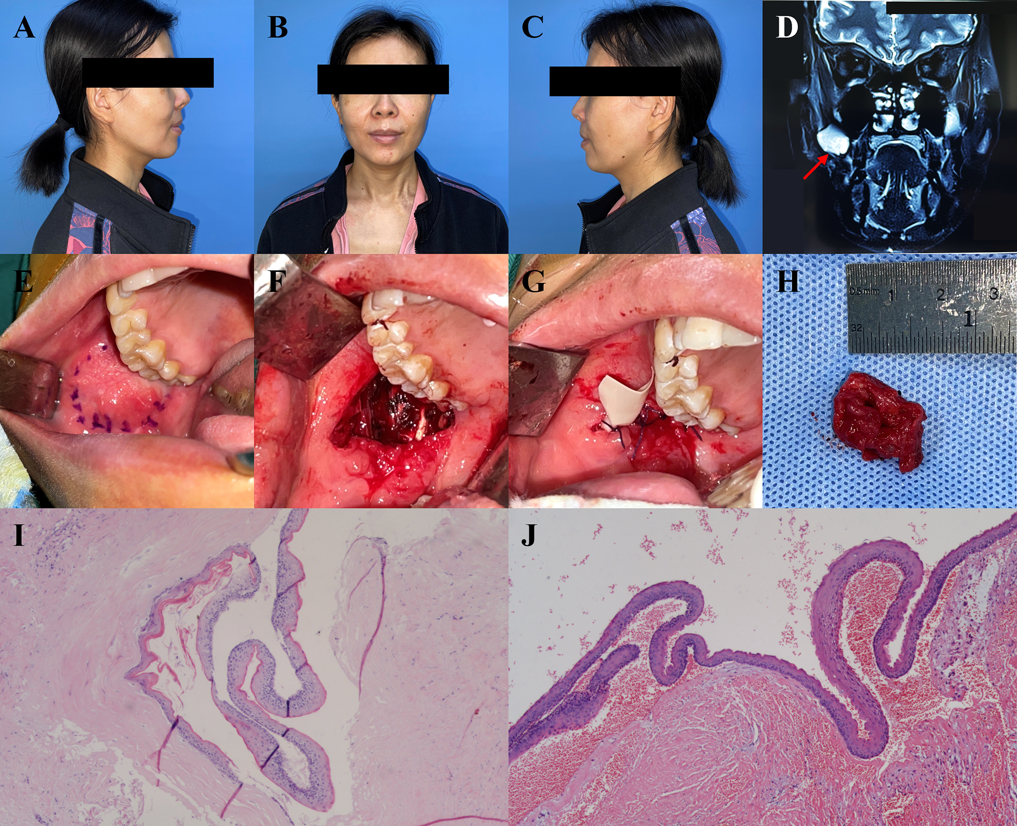 Clinical manifestations and treatment of peripheral odontogenic keratocysts: two cases and a literature review | Orphanet Journal of Rare Diseases