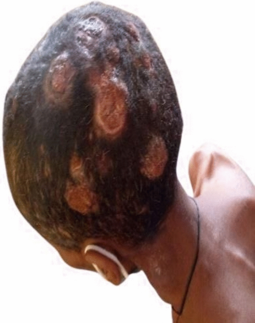 Case of cutaneous metastasis from presumed poorly differentiated thyroid carcinoma: a case report | Journal of Medical Case Reports