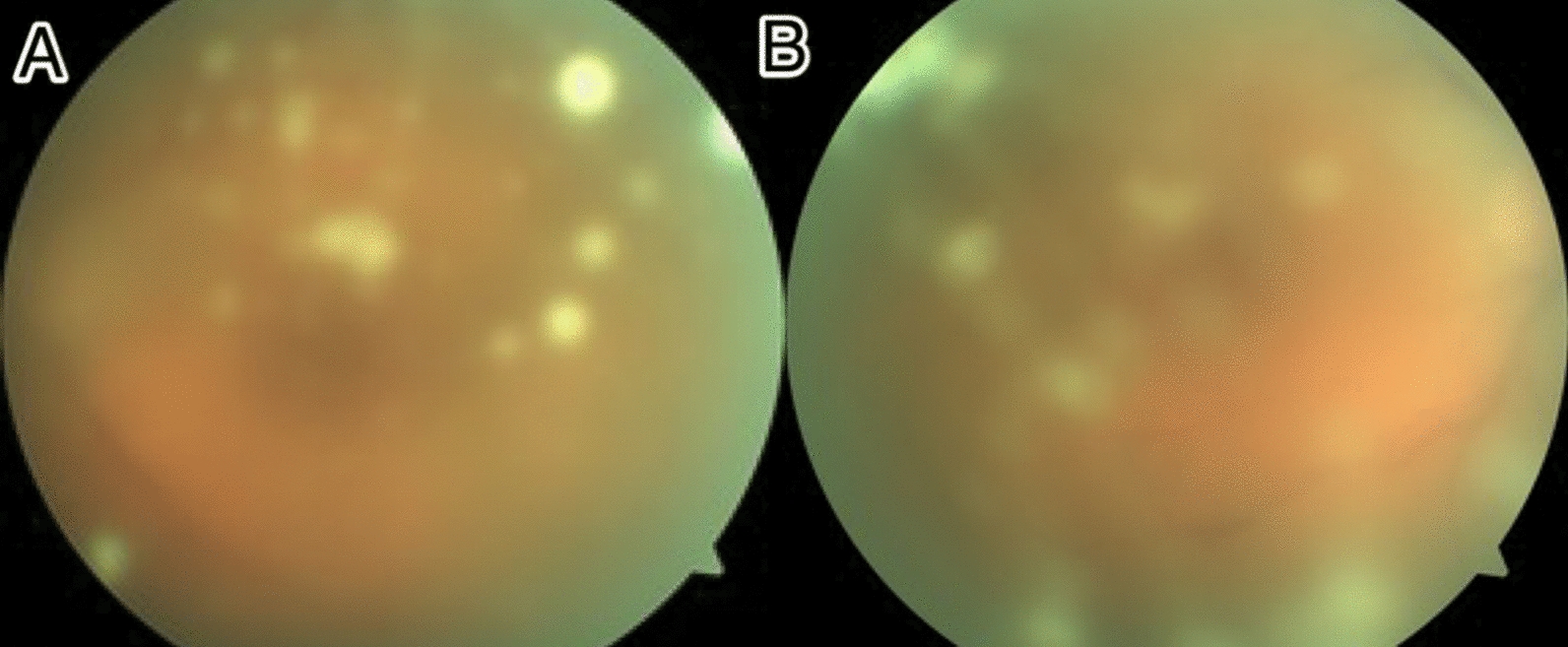 Post-coronavirus disease bilateral endogenous fungal endophthalmitis with full visual acuity recovery: a case report | Journal of Medical Case Reports