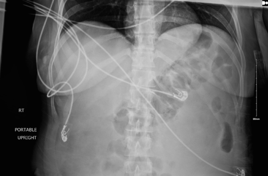 An acute presentation of Wunderlich’s syndrome with angiomyolipoma: a case report | Journal of Medical Case Reports