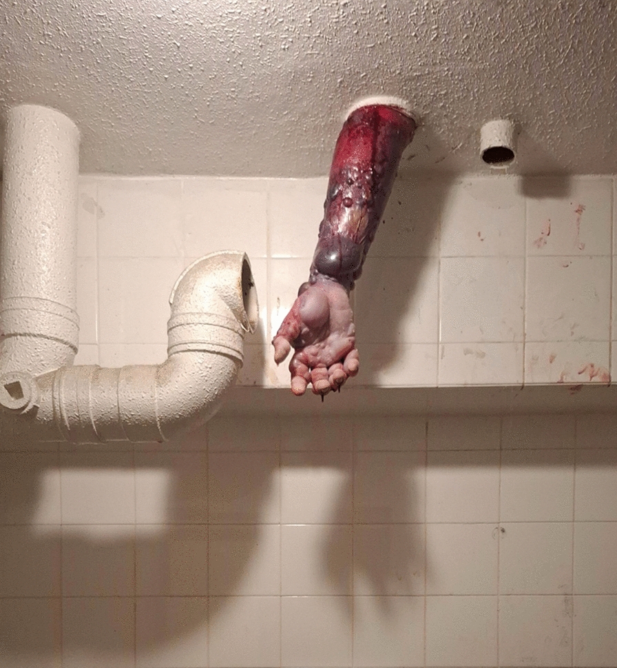 Importance of early prehospital intervention in crush injury and compartment syndrome: a case report | Journal of Medical Case Reports