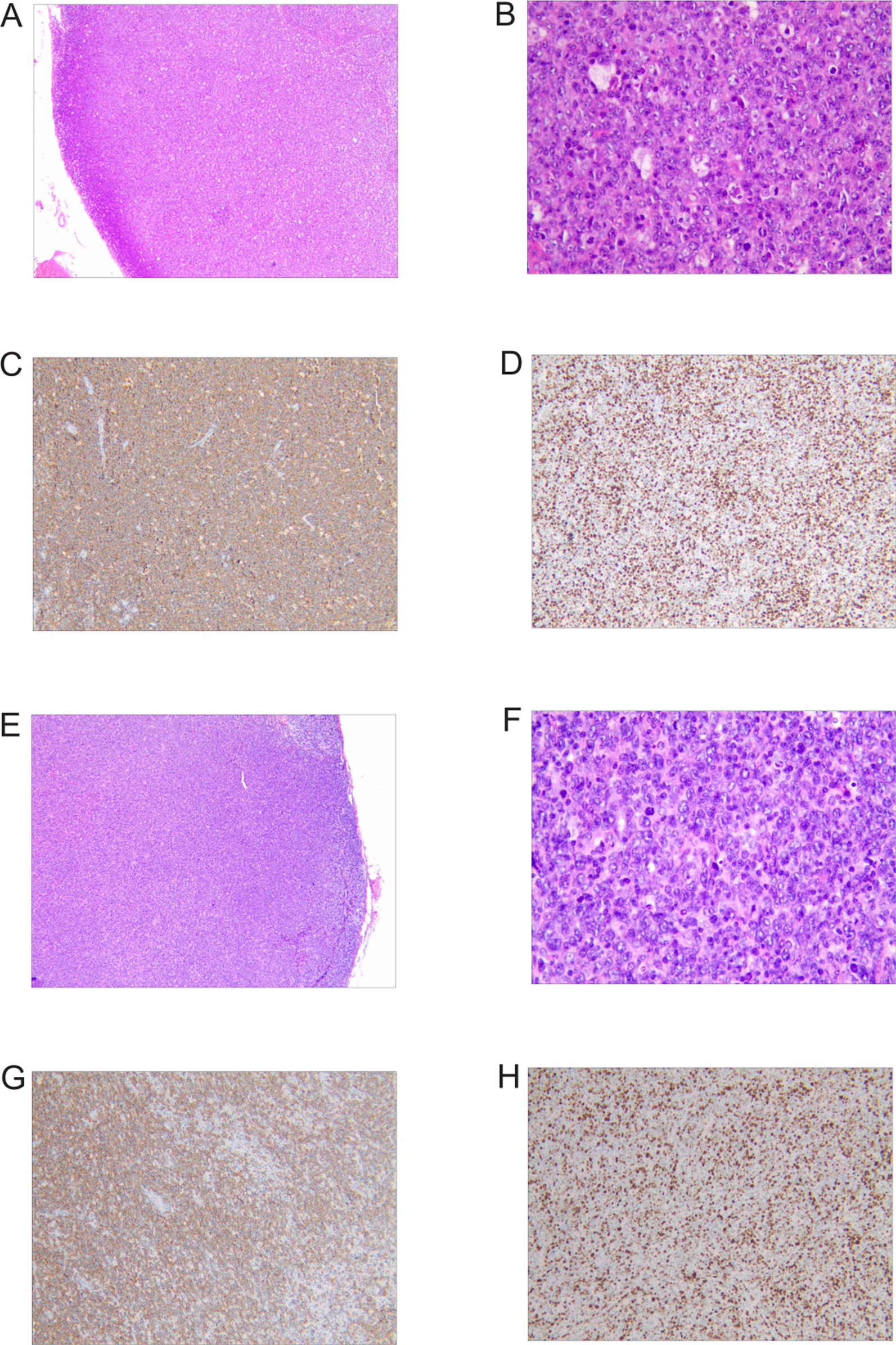 Cold versus warm autoimmune hemolytic anemia in diffuse large B cell lymphoma: pathogenic and therapeutic implications: a case series | Journal of Medical Case Reports