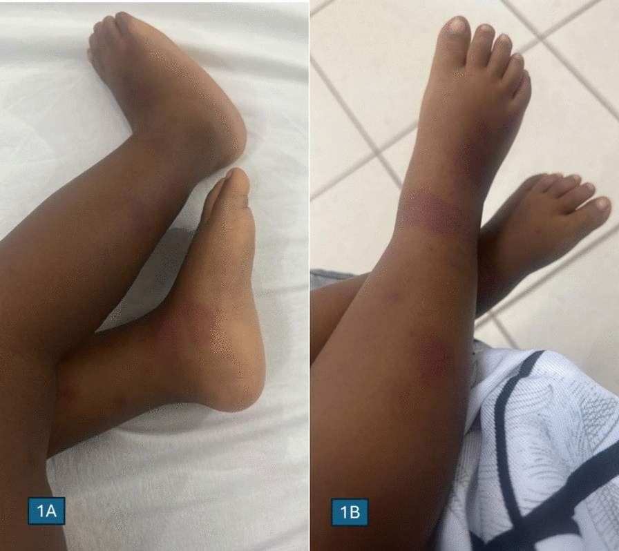 Mevalonate kinase deficiency (hyperimmunoglobulin D syndrome) in a Tanzanian girl: a case report | Journal of Medical Case Reports