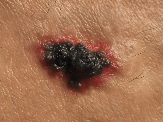 New Blood Test Promises Treatment Insights for Patients With Metastatic Melanoma