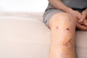 Call for papers – Quadriceps tendon autograft anterior cruciate ligament reconstruction