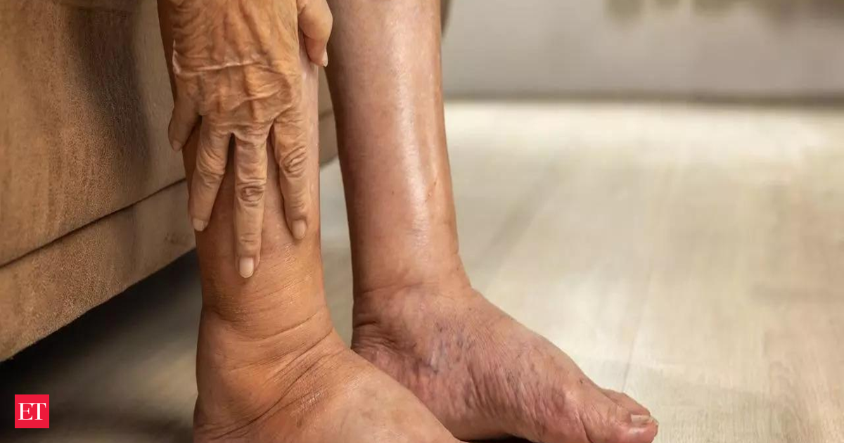 pancreatic cancer: ‘Silent killer’ pancreatic cancer symptoms might show up in your legs: Don’t ignore these warning signs, say experts