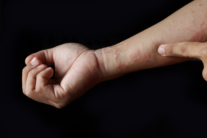 Moisturizing Cream with Ethanol May be Safe for People with Atopic Dermatitis