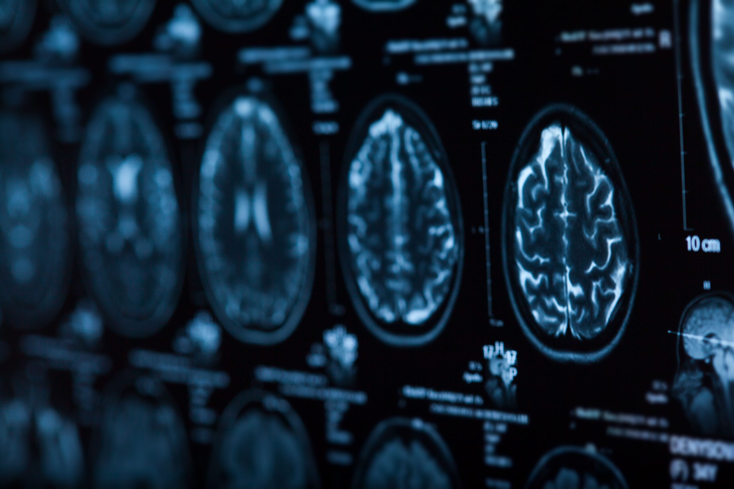 Earlier Menopause, Reduced Cardiac Function Potentially Linked With Negative Impacts on Brain Health