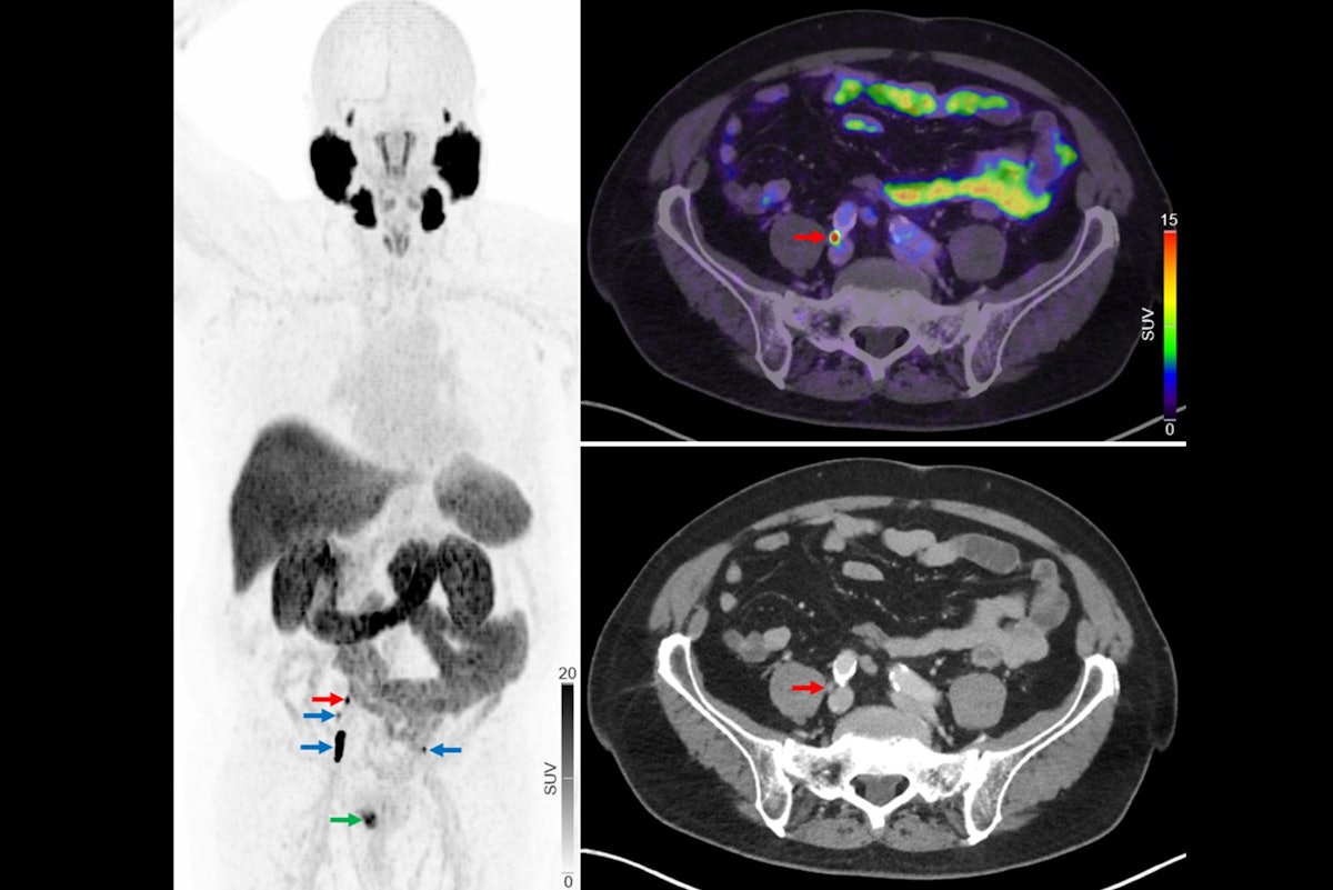 PSMA-PET/CT may replace NaF-PET/CT in advanced prostate cancer