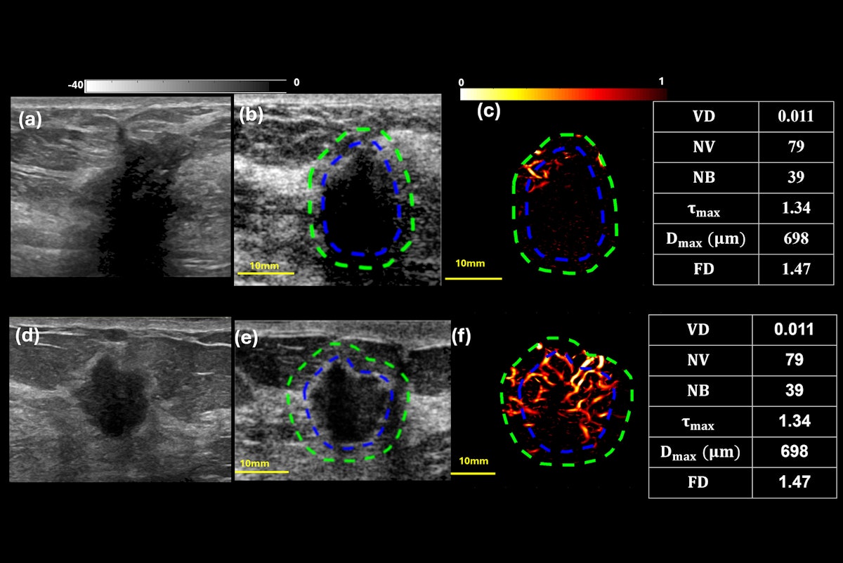 qHDMI differentiates radial scars from invasive breast cancer