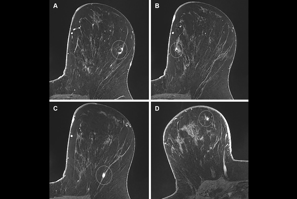 Auditing preop MRIs is feasible under upcoming BI-RADS recommendations