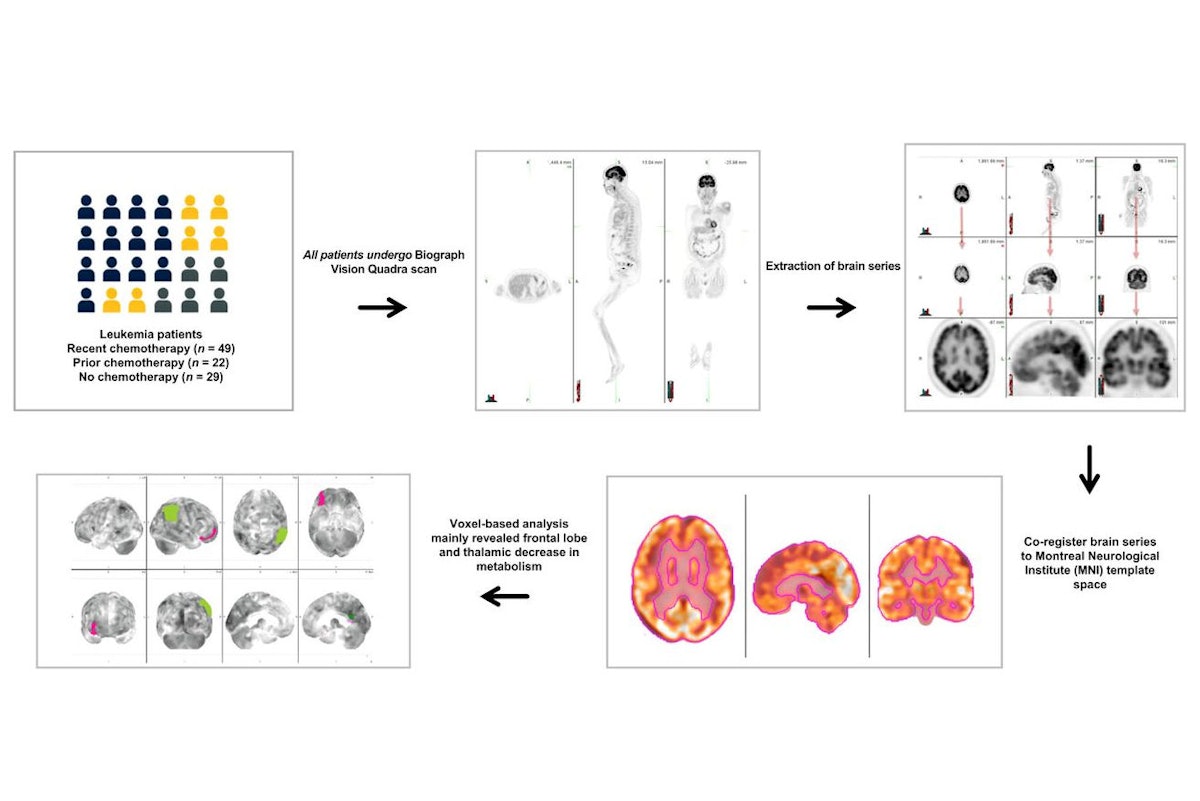 PET/CT reveals ‘chemo brain’ regions in leukemia patients