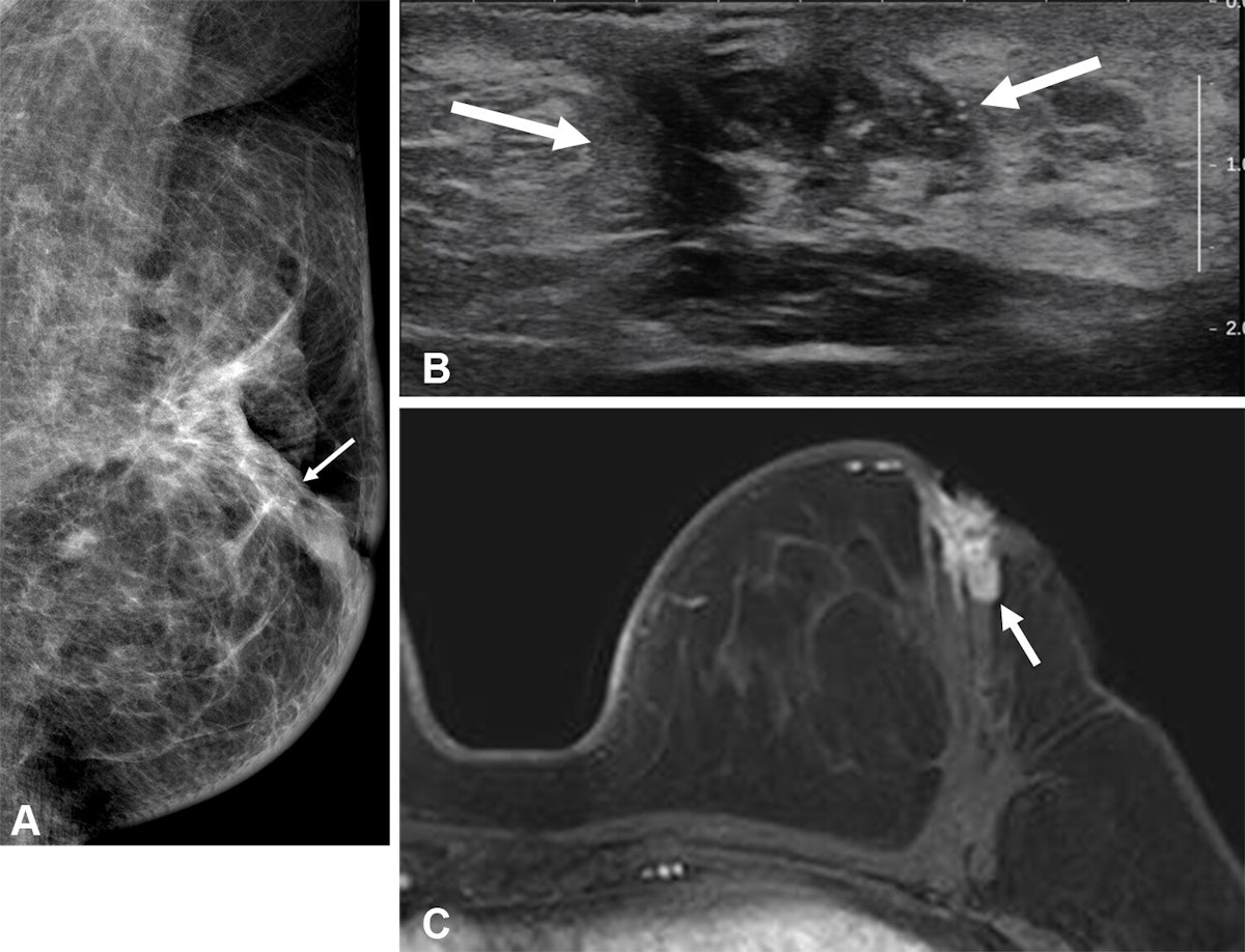 Preop MRI lessens younger women’s risk of breast cancer recurrence
