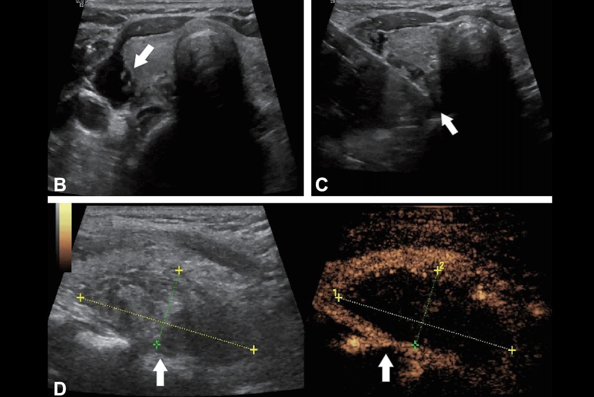 Ablation procedures cure thyroid disorders in older patients