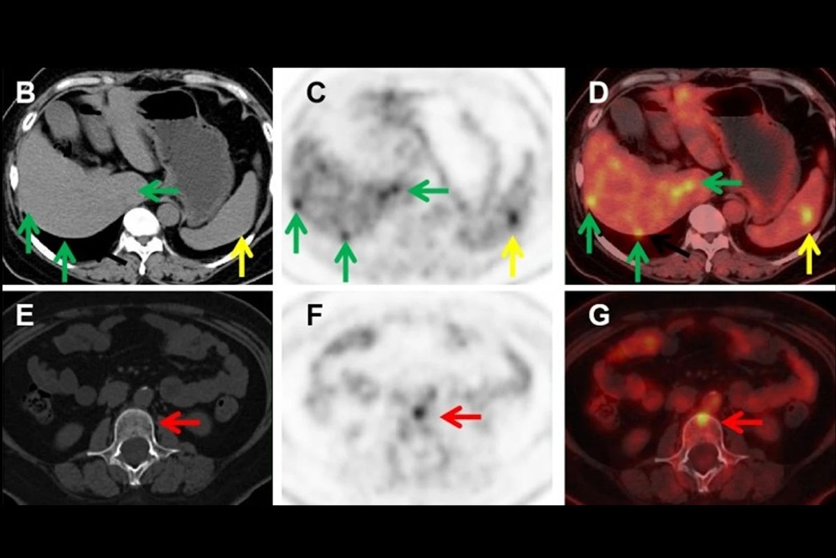 FDG-PET/CT detects metastatic eye tumors