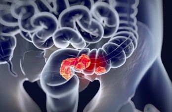 Adjuvant Therapy Confers Postoperative ctDNA Clearance, DFS Benefit in CRC