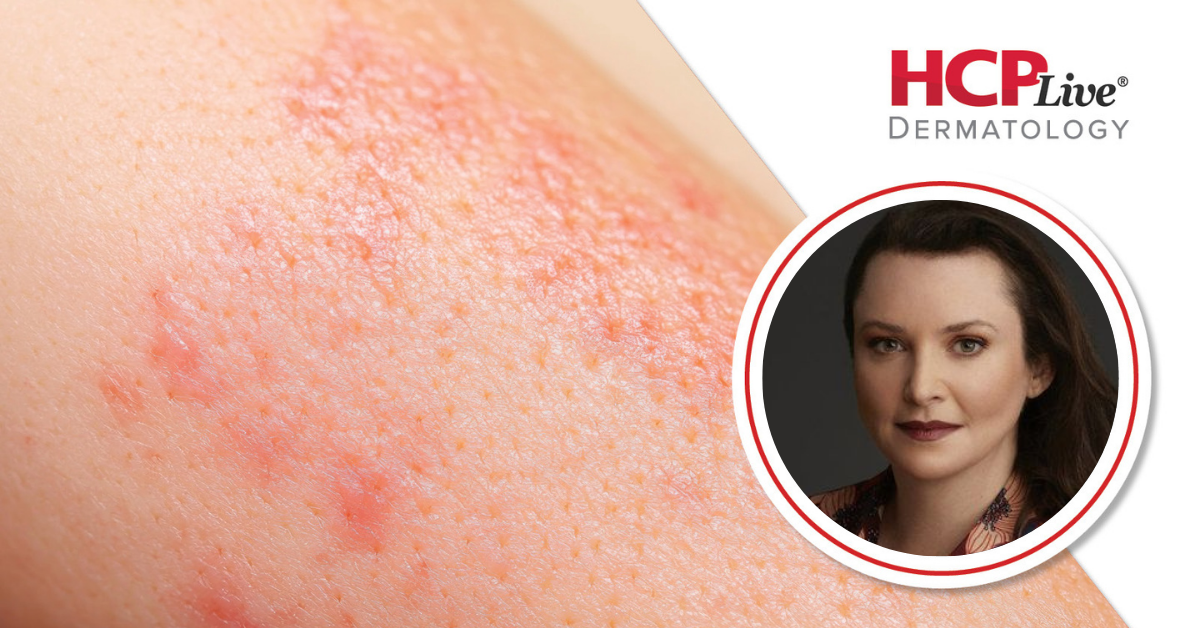 Phase 4 Dupilumab Findings on Atopic Dermatitis in Skin of Color, With Orit Markowitz, MD