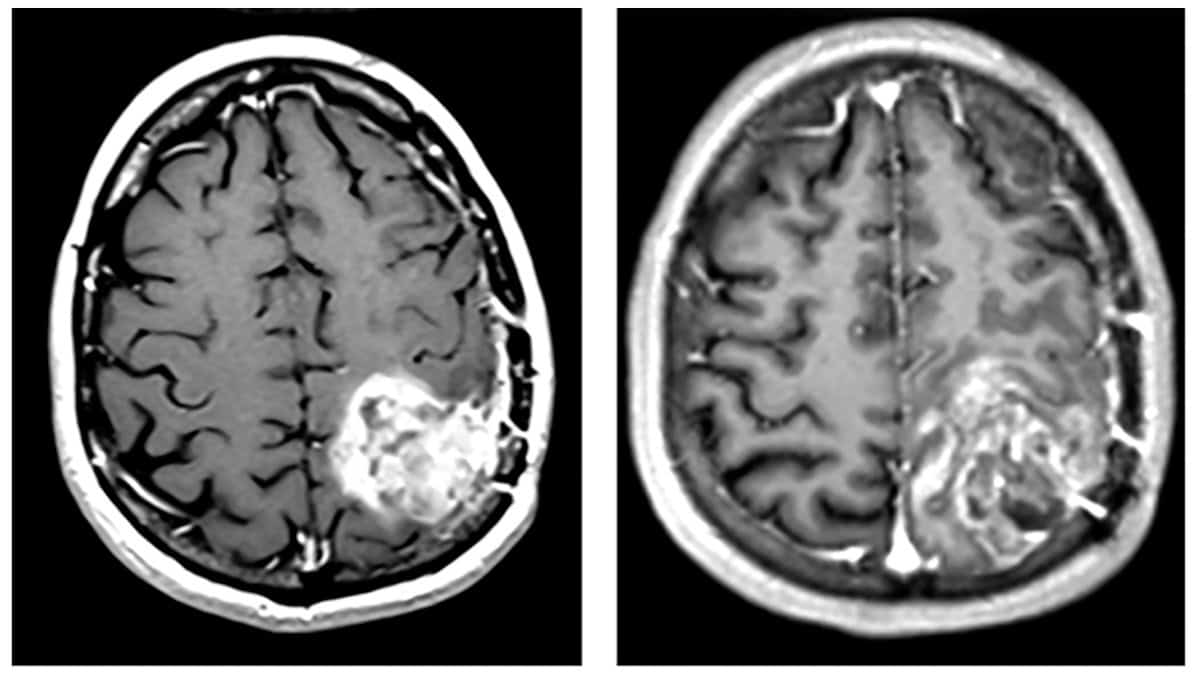 Tumour-specific radiofrequency fields suppress brain cancer growth – Physics World