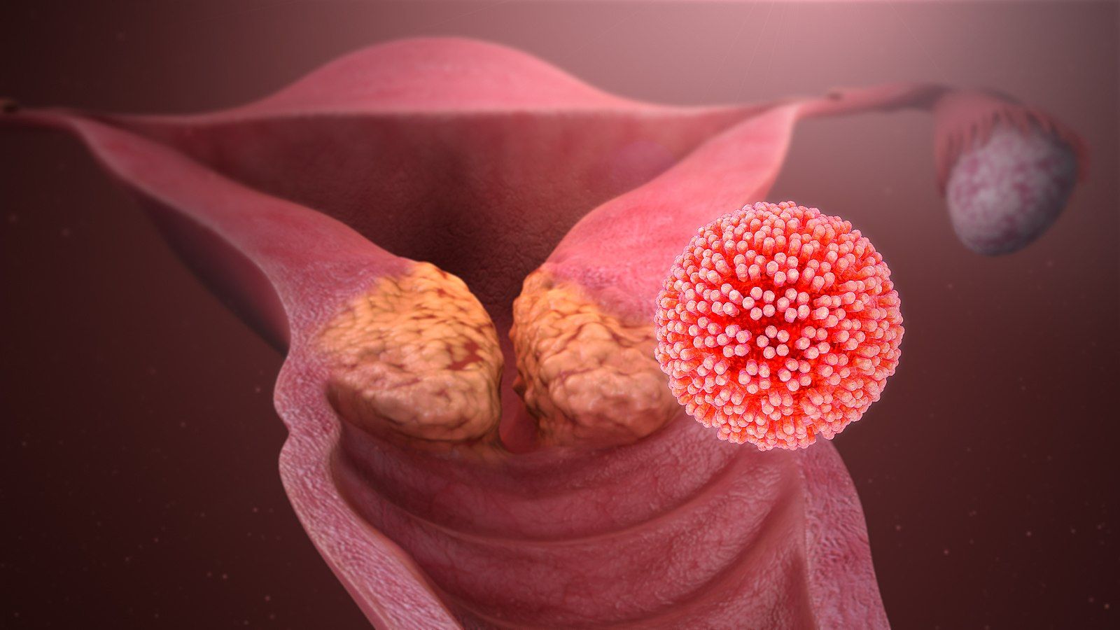CRT Does Not Improve RFS/OS, Confers High-Grade Toxicity in Cervical Cancer