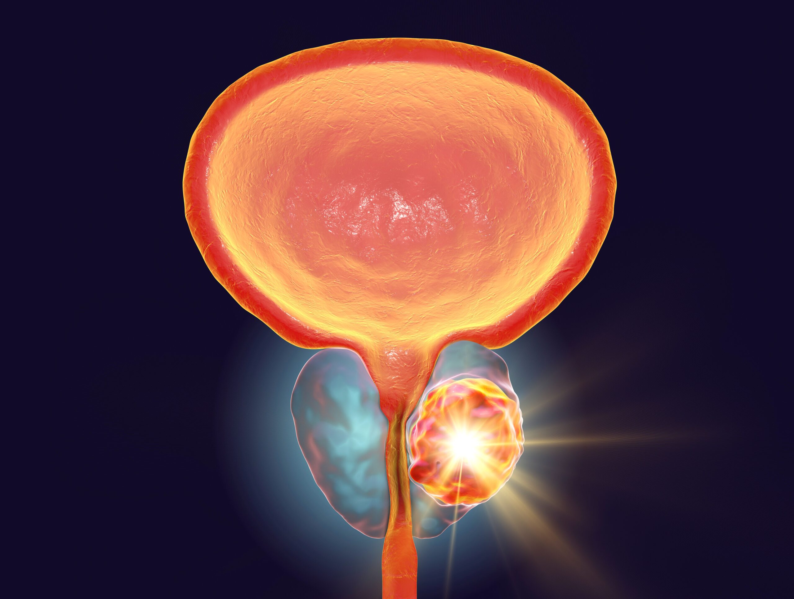 Enzalutamide/Leuprolide Regimen Reduces Risk of Death in Prostate Cancer