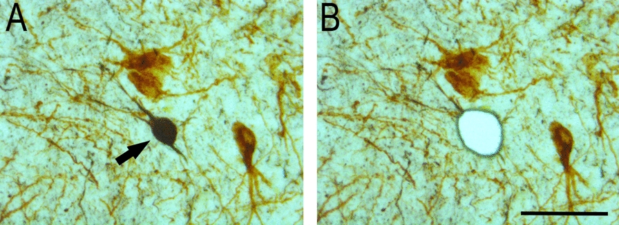 Neuronal gene profiling of tau oligomer-bearing cholinergic nucleus basalis neurons during the onset of Alzheimer’s disease | Acta Neuropathologica Communications