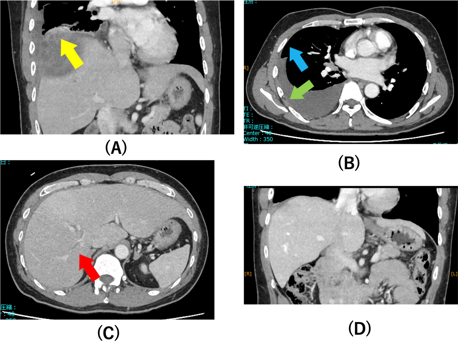 Intrathoracic rupture of amebic liver abscess: a case report and literature review | Tropical Medicine and Health