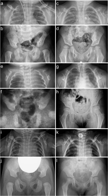 Missense variants in homeobox domain of PBX1 cause coracoclavicular ankylosis