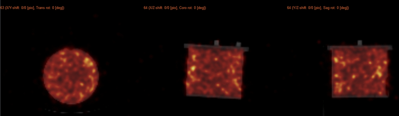 Fast SPECT acquisitions for single time-point dosimetry in 177Lu-PSMA for metastatic castration-resistant prostate cancer (mCRPC) patients | Egyptian Journal of Radiology and Nuclear Medicine