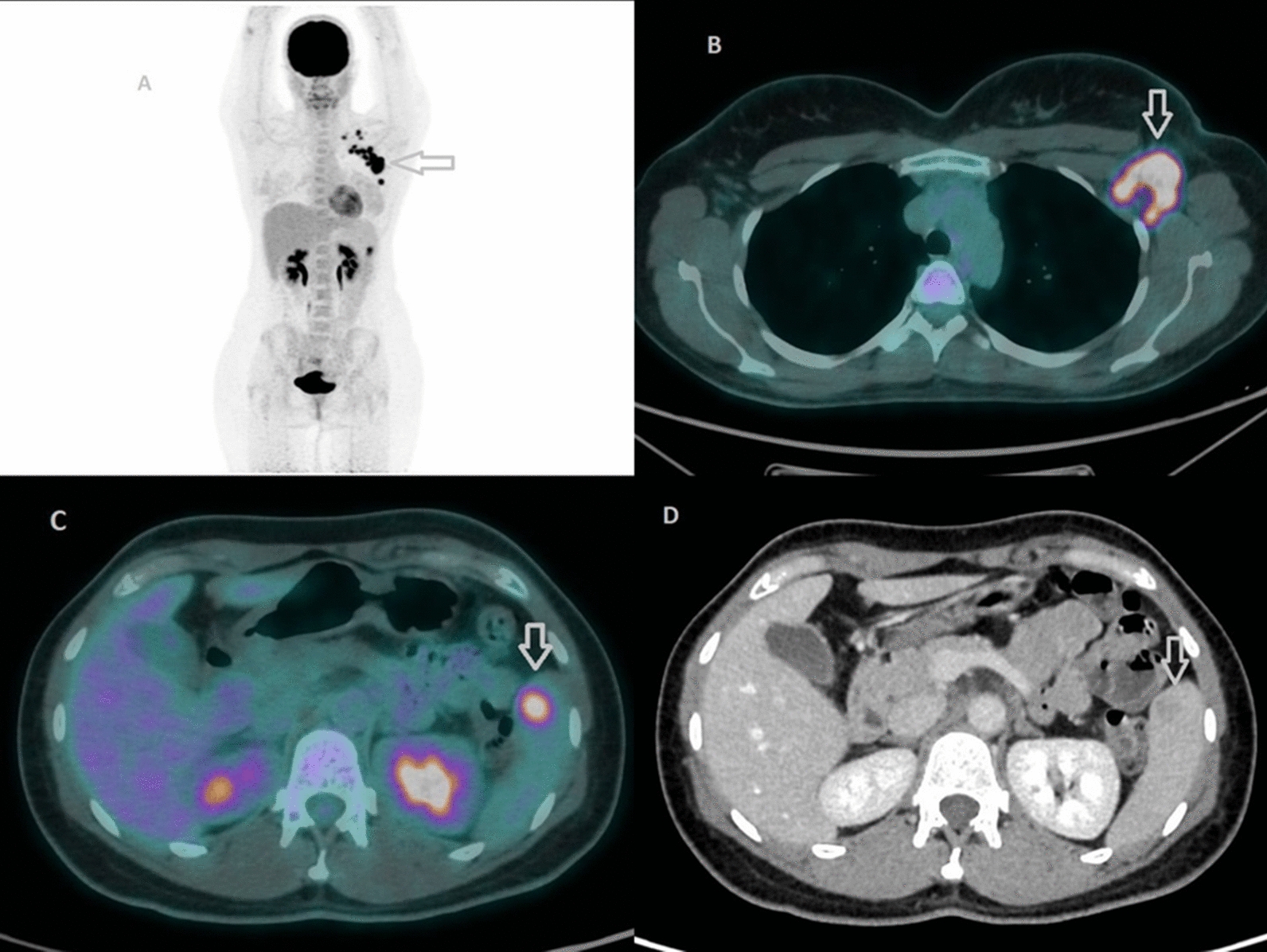 Reassessing a hypermetabolic splenic lesion in breast cancer: PET/CT findings and insights from multimodal imaging and multidisciplinary evaluation | Egyptian Journal of Radiology and Nuclear Medicine